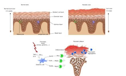 Natural Psoriasis Treatment-How PEMF Therapy Can Help