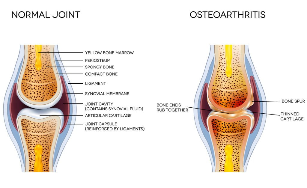 Treatment for OsteoarthritisA Holistic Approach PEMF Therapy Education