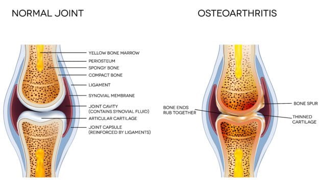 Treatment for Osteoarthritis-A Holistic Approach