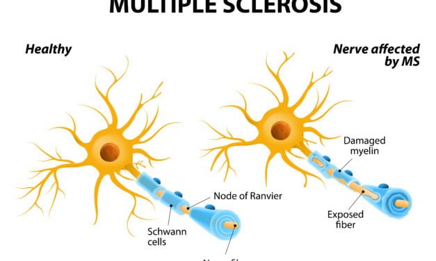 Symptoms of Multiple Sclerosis-is PEMF Therapy an Option?