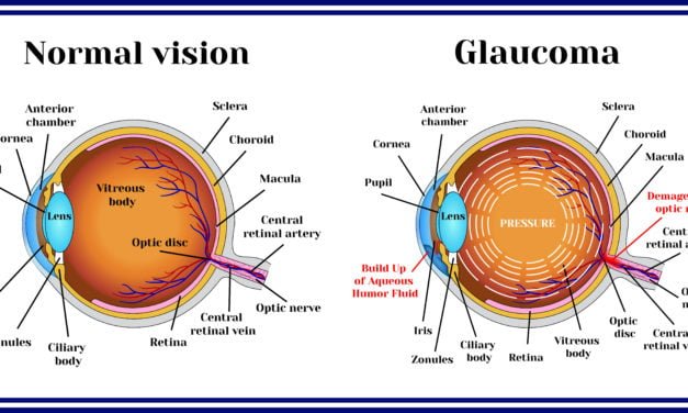 The Effectiveness of PEMF Therapy for Glaucoma