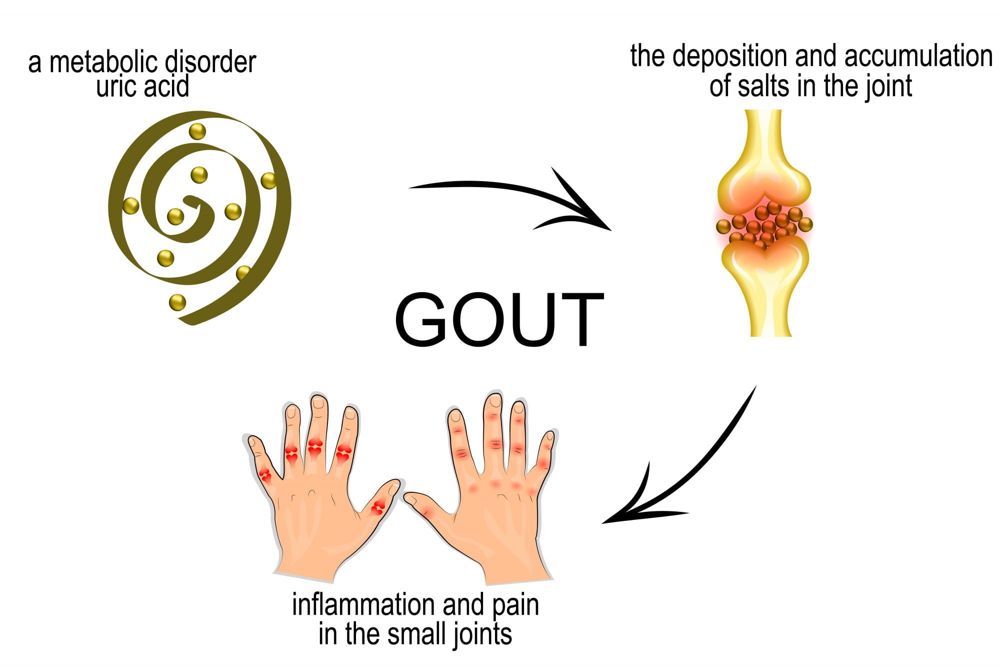Can PEMF Therapy Heal Gout? PEMF Therapy Education Can PEMF Therapy Heal Gout? PEMF Therapy Education