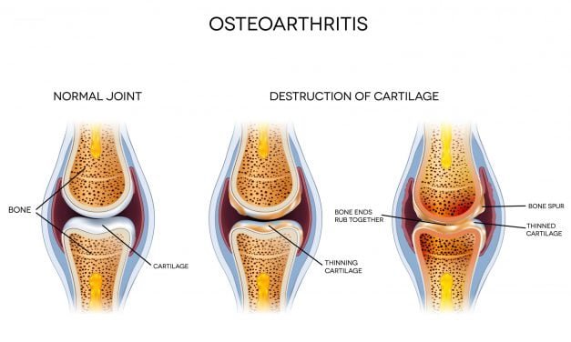 How PEMF Therapy Reduces Osteoarthritis Pain
