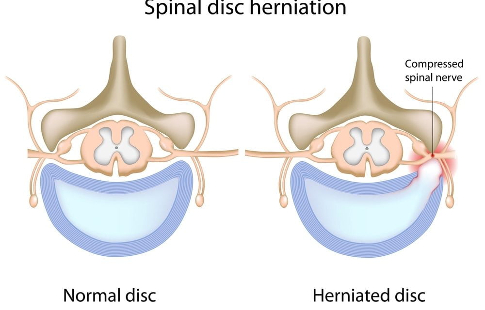 The Power of PEMF Therapy for Herniated Disc Pain