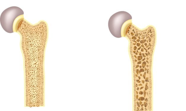 How PEMF Therapy is Changing the Lives of Osteoporosis Patients