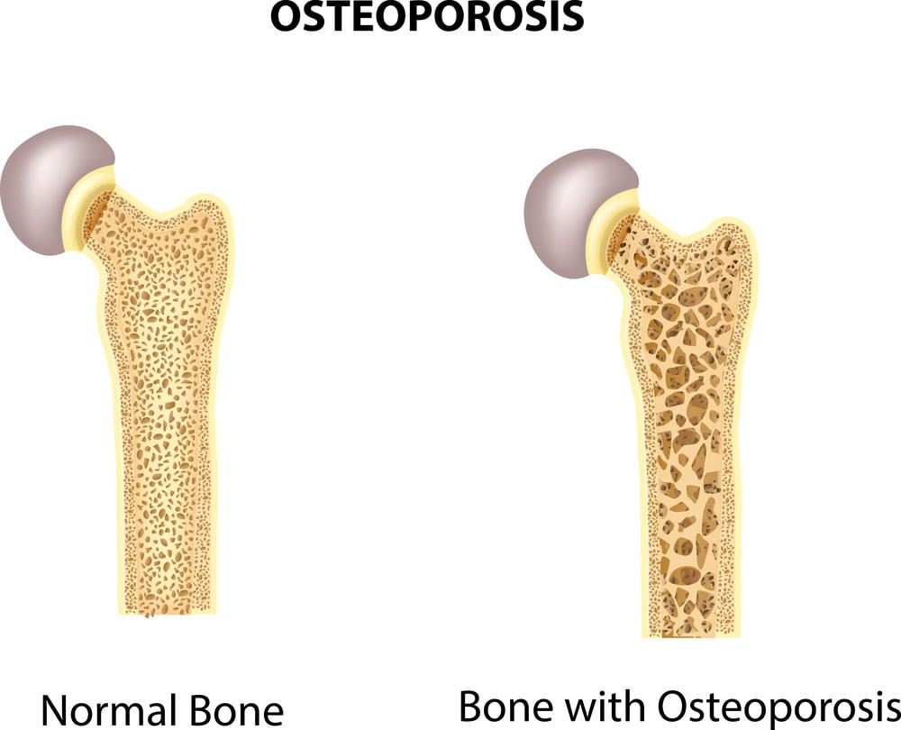 osteoporosis patients PEMF Therapy Education